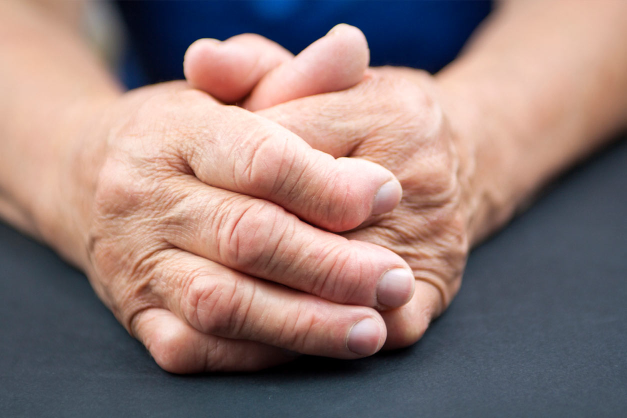 rheumatoid arthritis in the hands